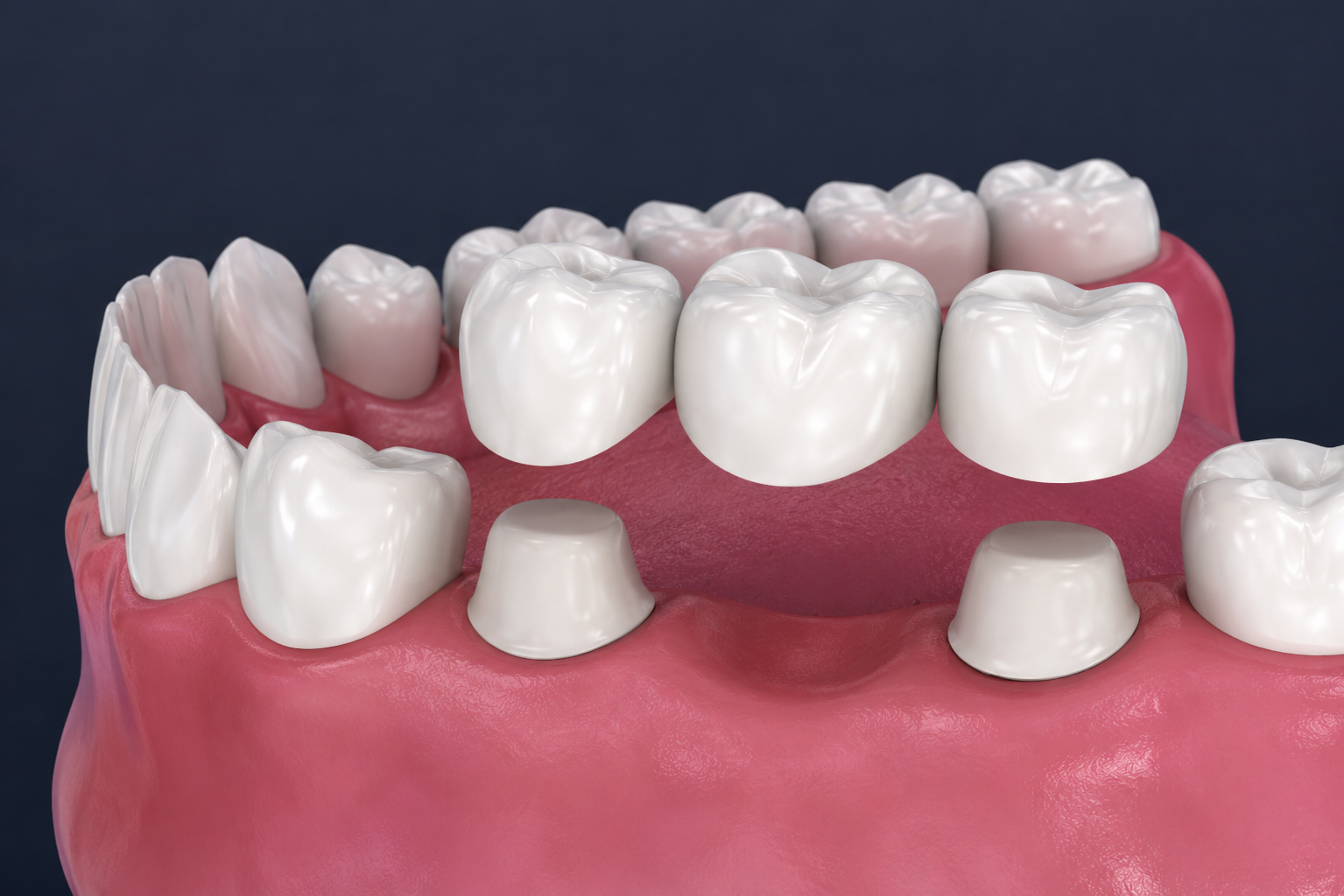 Patient with beautiful restored smile after crown and bridge treatment