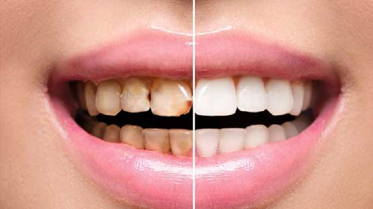 Full mouth dental rehabilitation treatment setup